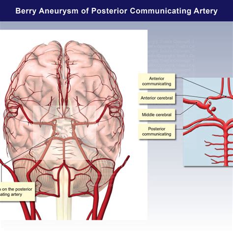 berry aneurysm of posterior communicating artery trialexhibits inc