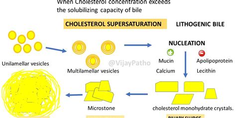 Gall Stonescholelithiasis Pathogenesis Pathology Made Simple