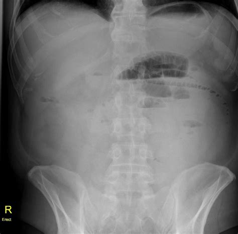 Adhesional Small Bowel Obstruction Radiology Case