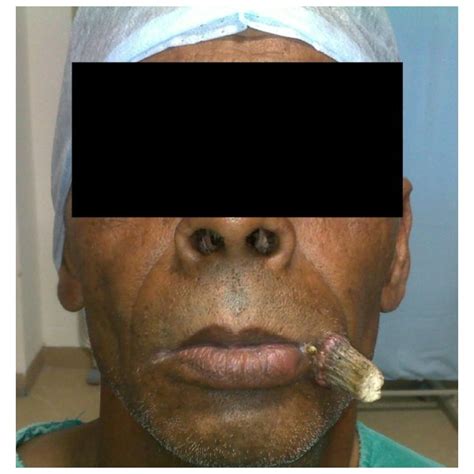 Pdf Carcinoma Buccal Mucosa Underlying A Giant Cutaneous Horn A Case