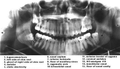 Panoramic Radiograph Anatomy Anatomy Diagram Source