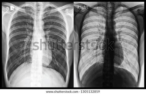 Using x ray in photoshop allows you to remove clothing, reveal hidden details, and create a magical appearance that is sure to draw the eye. Normal Chest Xray High Resolution Pa Stock Photo (Edit Now) 1305132859