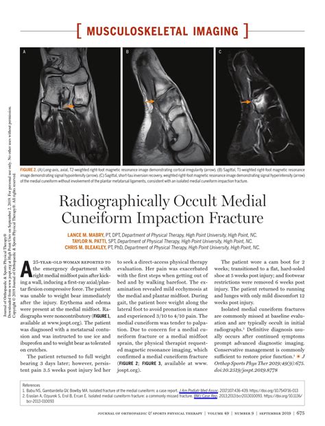 Pdf Radiographically Occult Medial Cuneiform Impaction Fracture