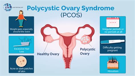 Polycystic Ovary Syndrome Pcos Causes Signs And Symptoms Lab