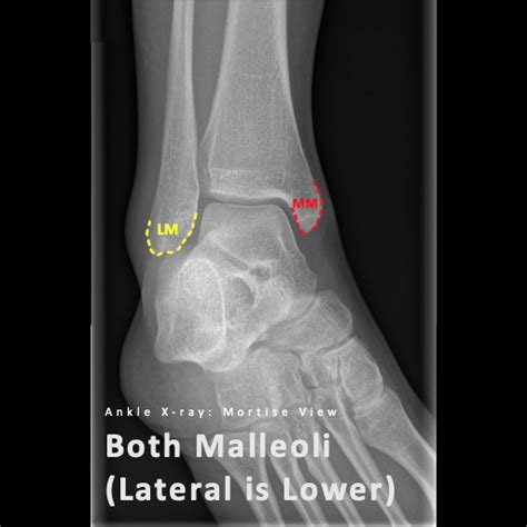 Approach To Ankle Mortise View Pulse Md