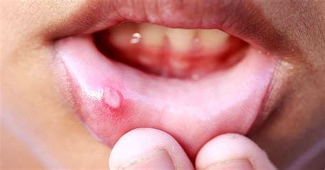 Some common factors known to trigger their growth are: ORAL MEDICINE : What causes mouth ulcers?