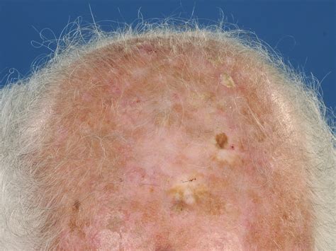 Actinische keratosen (keratosis actinica) (patientenfolder)