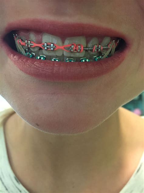 Pin By •jaidyn Coots• On Braces Braces Colors Cute Braces Dental Braces