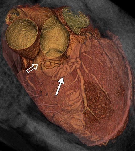 Coronary Artery Fistulas Pathophysiology Imaging Findings And