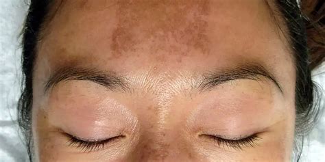 Brown Spots On Forehead