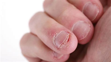 How To Treat Ingrown Fingernails At Home Effective Methods