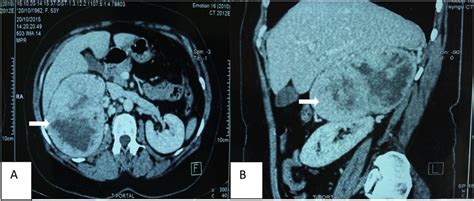 A Axial Contrast Enhanced Ct Image Showing A Circumscribed Right