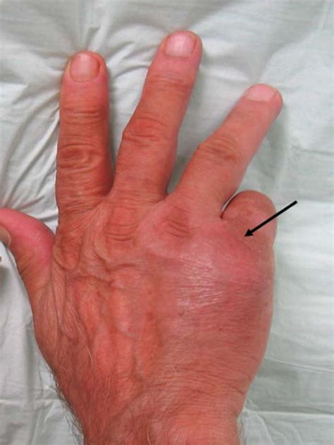 The Swelling At The Dorsal Part Of The Hand Over The 5t Open I