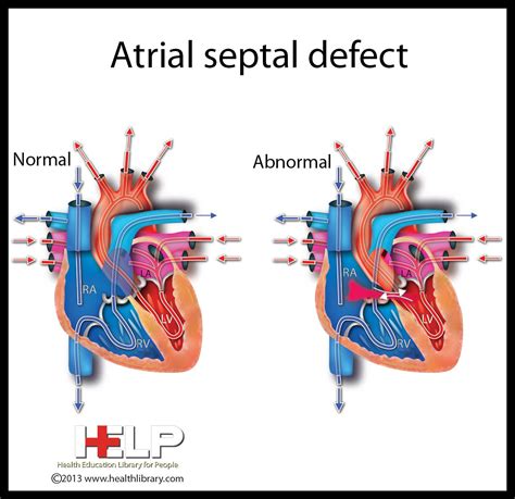 Atrial Septal Defect Technical Term For Laycis Condition Atrial