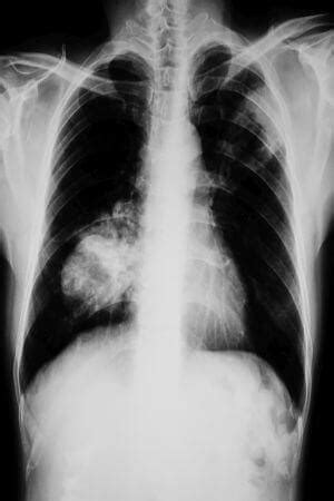 Lungenkrebs Symptome Diagnose Und Behandlung Bei Lungenkrebs