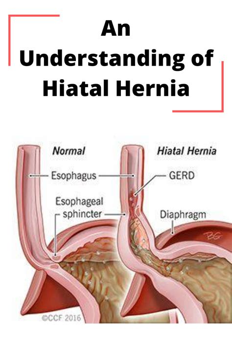 An Understanding Of Hiatal Hernia Understanding Health Fitness