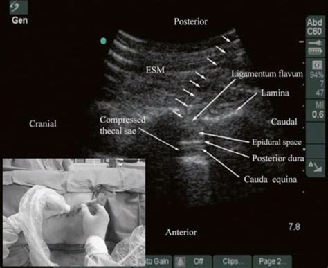 Ultrasound Guided Central Neuraxial Blocks Nysora