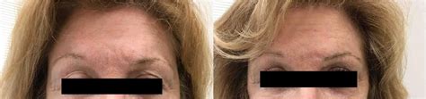 Exilis Ultra Skin Tightening Before And After Photo Gallery Washington