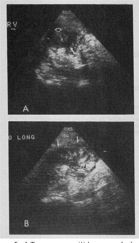 Figure 1 From Sonographic Observations In A Patient With Typhlitis