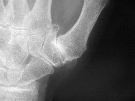 Arthritis Basal Joint Arthritis