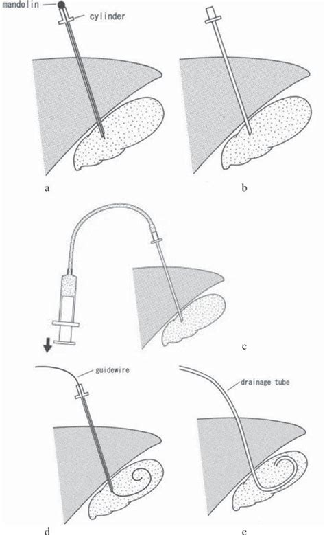 Percutaneous Transhepatic Gallbladder Drainage Ptgbd Procedure A A