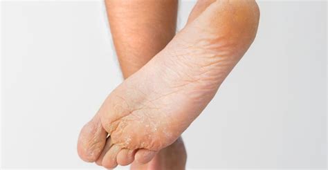 Hyperhidrosis Of The Feet Excessive Sweating Overactive Sweat Glands