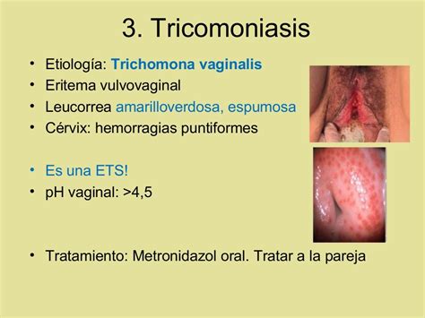 Vulvovaginitis