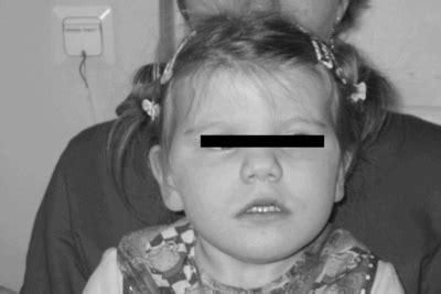 Epicanthal folds are defined as a condition in which skin of upper eyelid show skin folds towards inner corner of eye. Internet Scientific Publications