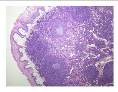 Figure 1 From A Rare Cause Of Tonsil Mass In A Child Lymphoid Polyp