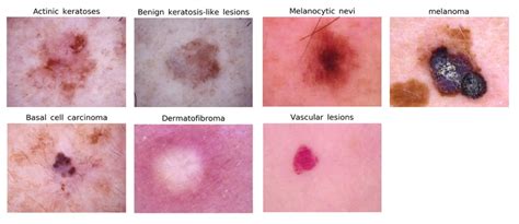 Skin Lesion Classification Based On Deep Ensemble Convolutional Neural