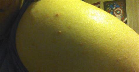 long time lurker first post woke up with some pimples on my big fat arm imgur
