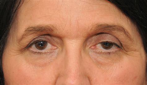 Causes Of Droopy Eyes And Eyelids