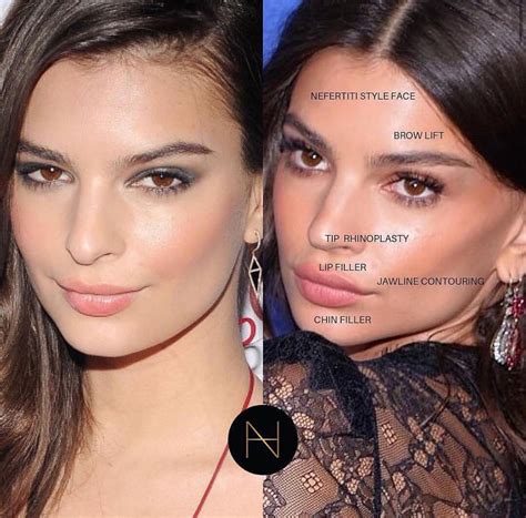 Celebrity Brow Lift Before And After