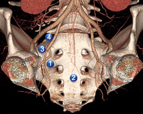 Lymphatic Metastases From Pelvic Tumors Anatomic Classification