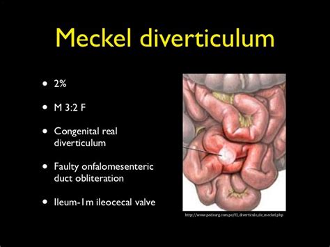 Diverticulums Bowel Cancer
