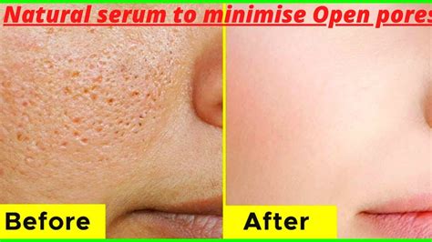 Serum To Reduce Open Pores 😍 How To Minimise Pores Open Pores Natural Treatment Large Pores