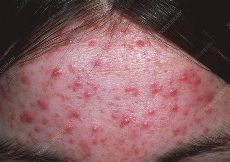 Acne On Forehead Stock Image M1080492 Science Photo Library
