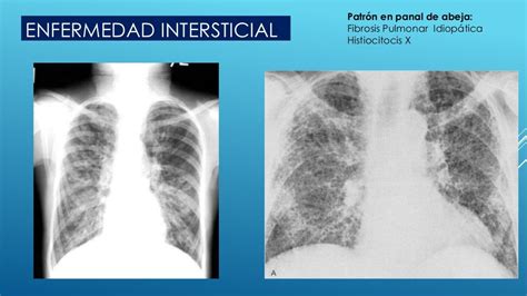 Enfermedad Pulmonar Intersticial Difusa