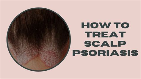 How To Treat Scalp Psoriasis Youtube
