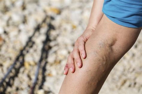 What To Do When A Varicose Vein Bursts 8 Steps