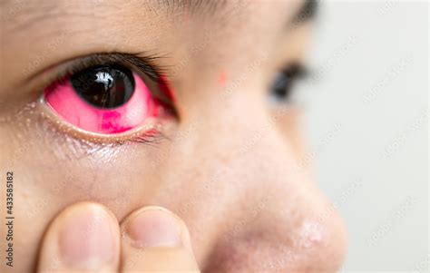 Asian Lady Woman With Conjunctivitis Is Checking For Her Pink Eye Girl