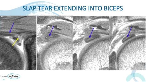 Slap 4 Tears The Best Way To Find Biceps Extension Of The Tear On Mri