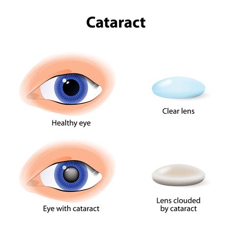 Cataract Awareness What Are Cataracts Clinica London