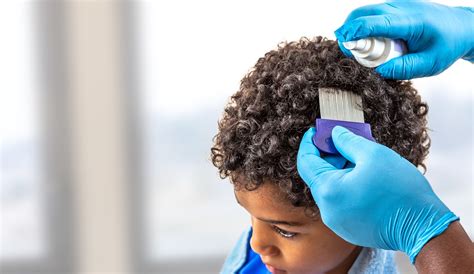The Perfect Prescription For Head Lice Removal | Lice ...
