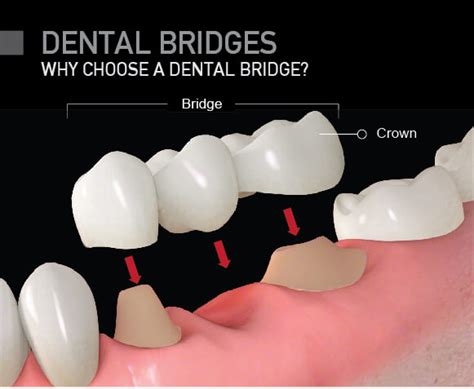 Dental Bridges Why Choose A Dental Bridge Over A Dental Implant
