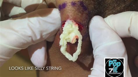 Neck Cyst Popping Site