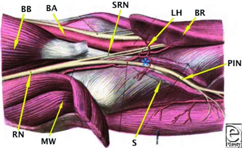 Posterior Interosseous Nerve Compression