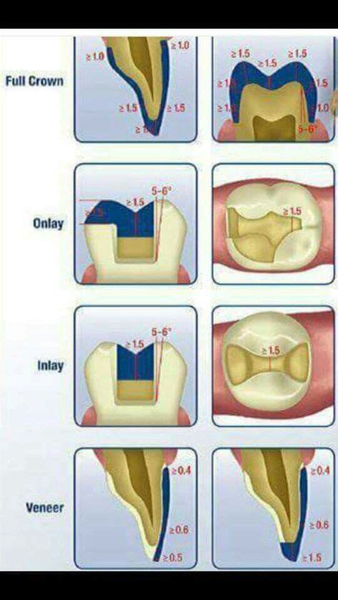 Wisdom Tooth Extraction Dental Crowns Dental Dental Life