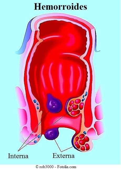 Hemorroides externas y internas, síntomas, causas ...