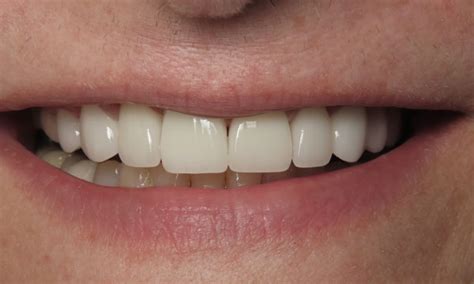 Smile Makeover Gallery Before And After Dr Rick Dentistry